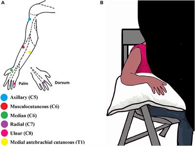 Unilateral Brachial Plexus Lesion Impairs Bilateral Touch Threshold